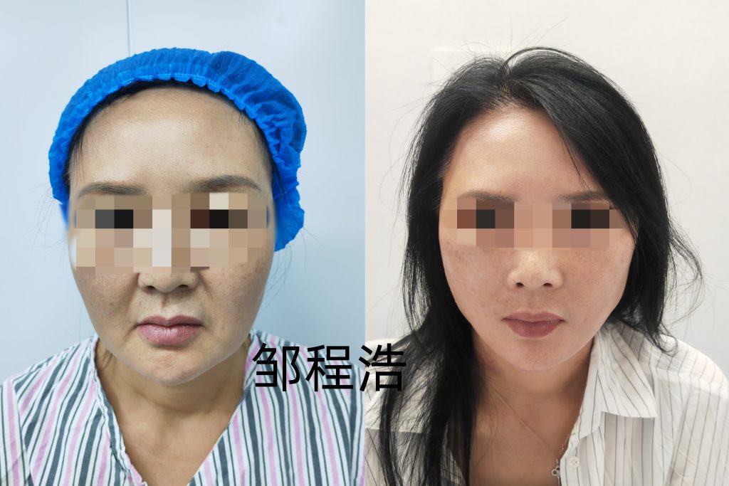 拉皮种类繁多,常常让人一头雾水?其实,是因为还没掌握拉皮背后的门道。今天,就来给大家详细剖析,一次性弄懂拉皮的原理。 2 微信图片 20250117235457 1