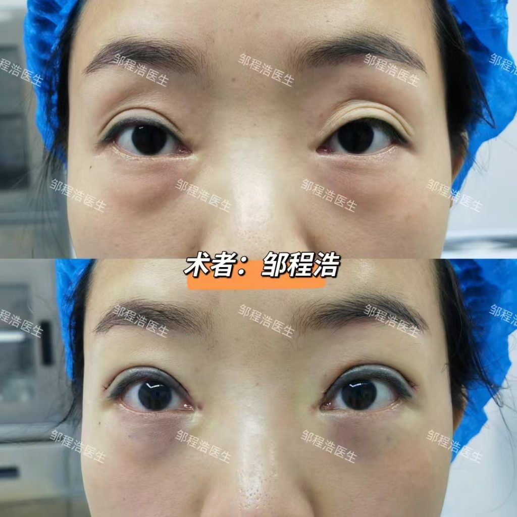 “双眼皮手术,你选对了吗?三种方法各有所长” 2 微信图片 20250214211059 1