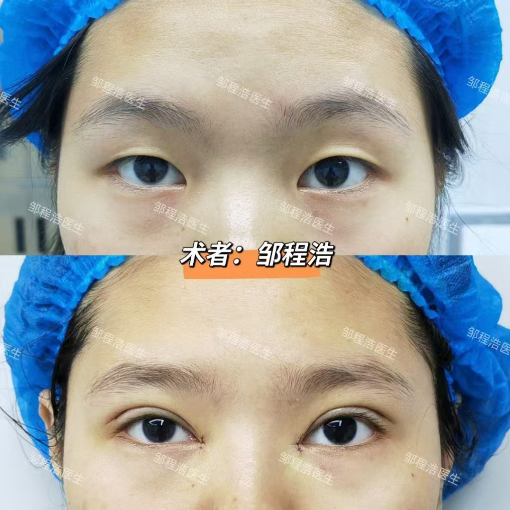 “双眼皮手术,你选对了吗?三种方法各有所长” 1 微信图片 20250214211107 1