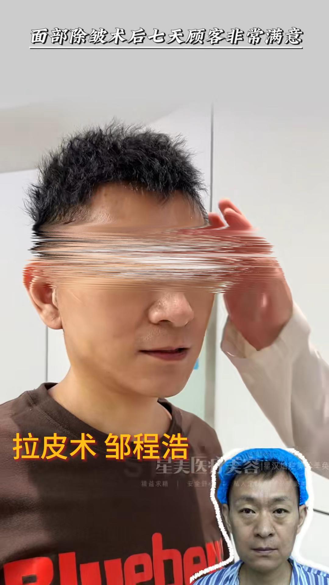 男士拉皮的魅力
