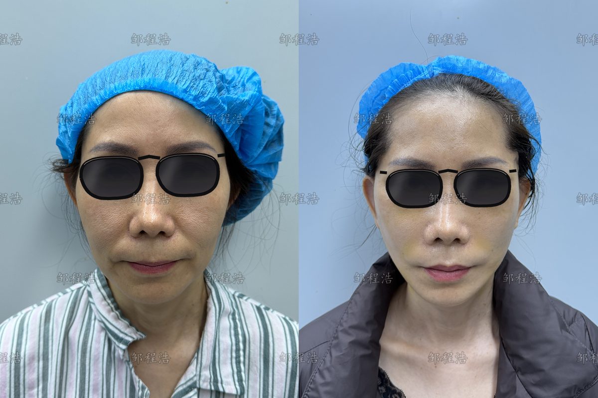 什么情况需要做拉皮修复?常见的五类问题与原因 1 拉皮修复术前术后对比示意(眼部已遮挡)1