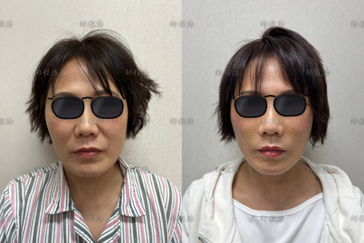 鼠耳畸形术前术后对比示意（眼部已遮挡）1