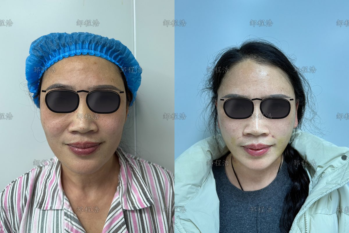 高位SMAS拉皮术前术后对比示意（眼部已遮挡）1