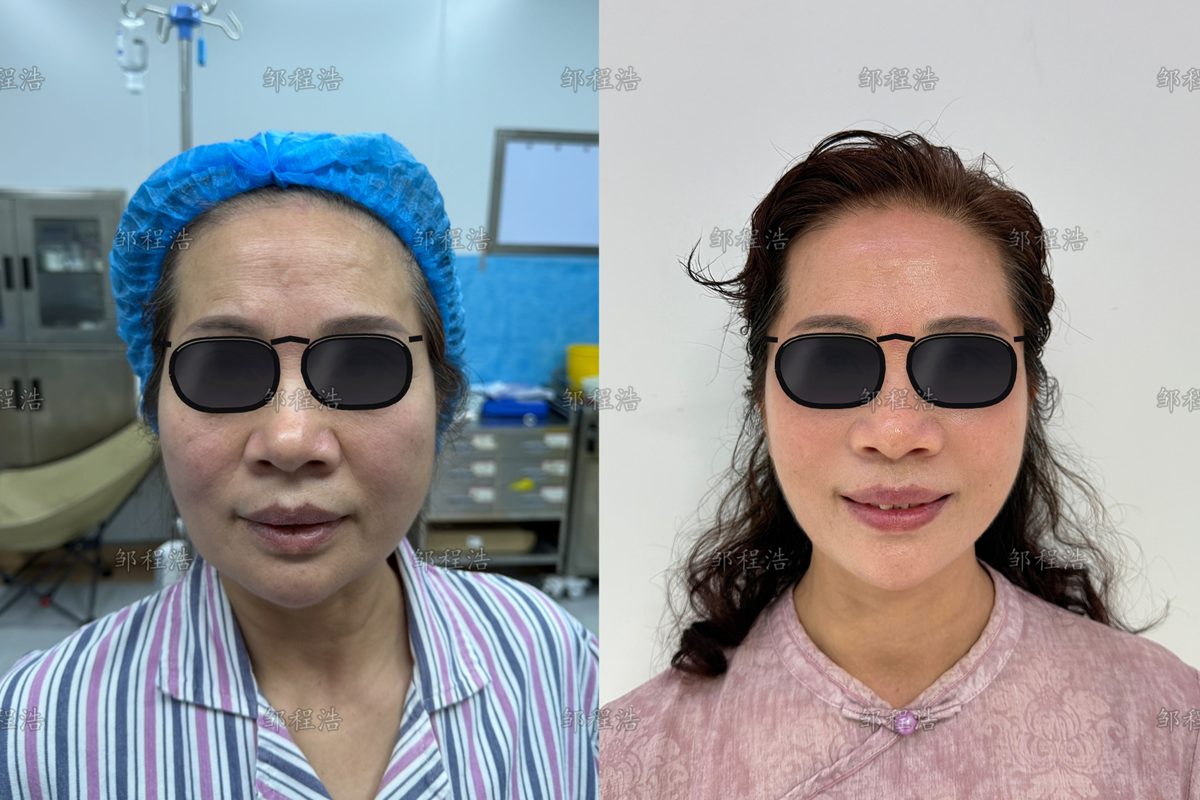 什么情况需要做拉皮修复?常见的五类问题与原因 2 拉皮修复术前术后对比示意(眼部已遮挡)2