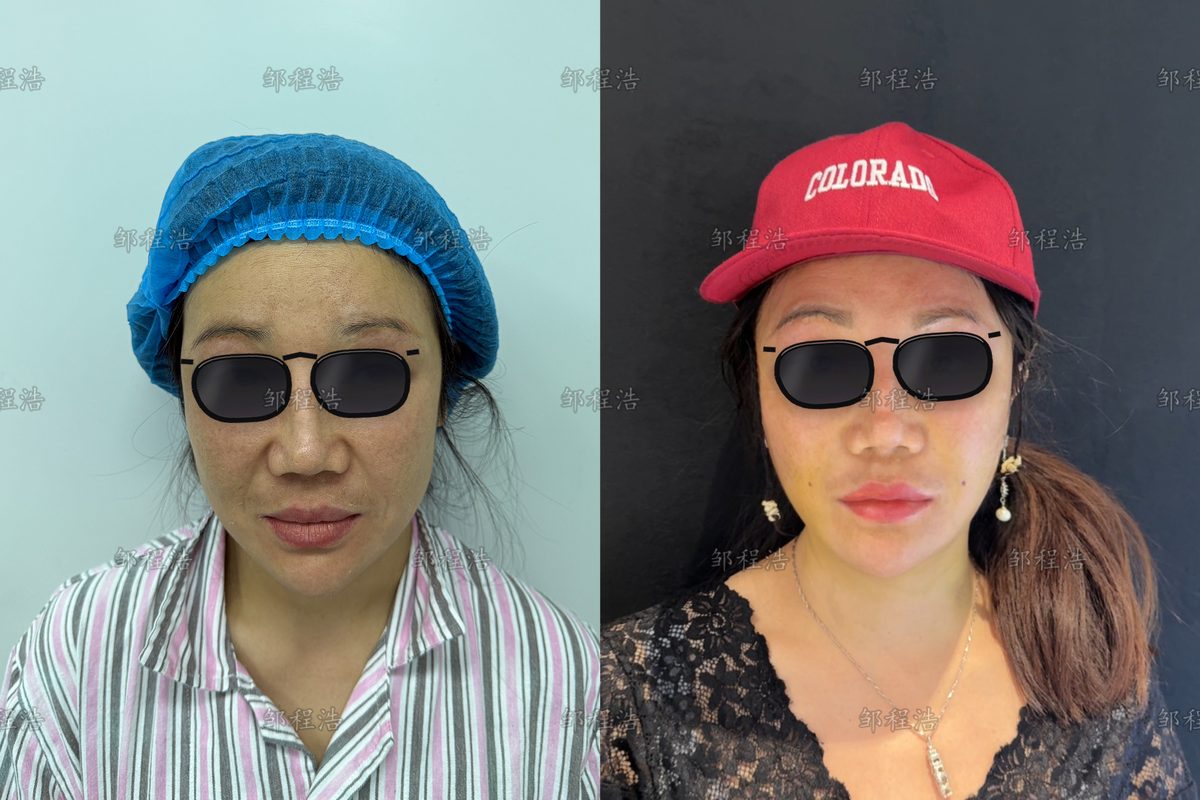 高位SMAS拉皮术前术后对比示意（眼部已遮挡）2