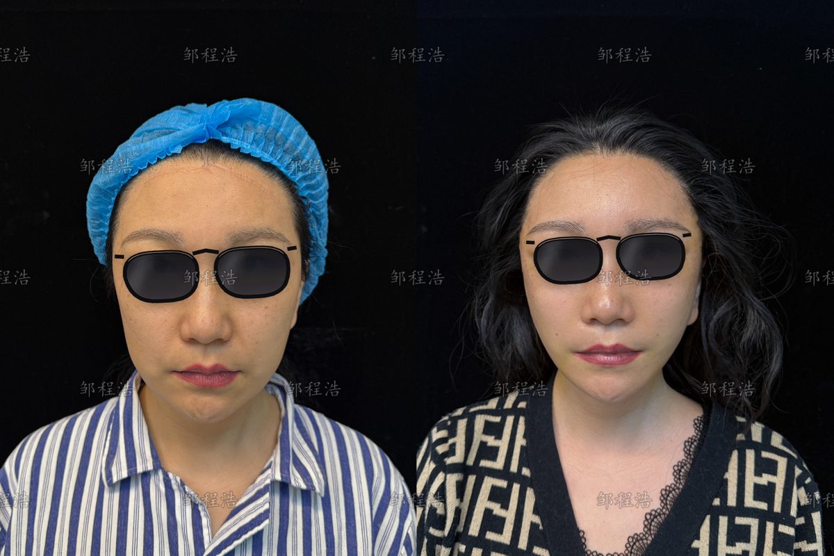 做过线雕还能拉皮吗?为什么不建议做线雕 2 线雕后拉皮术前术后对比示意(眼部已遮挡)2