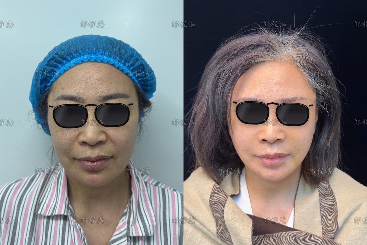 拉皮术后恢复术前术后对比示意（眼部已遮挡）2